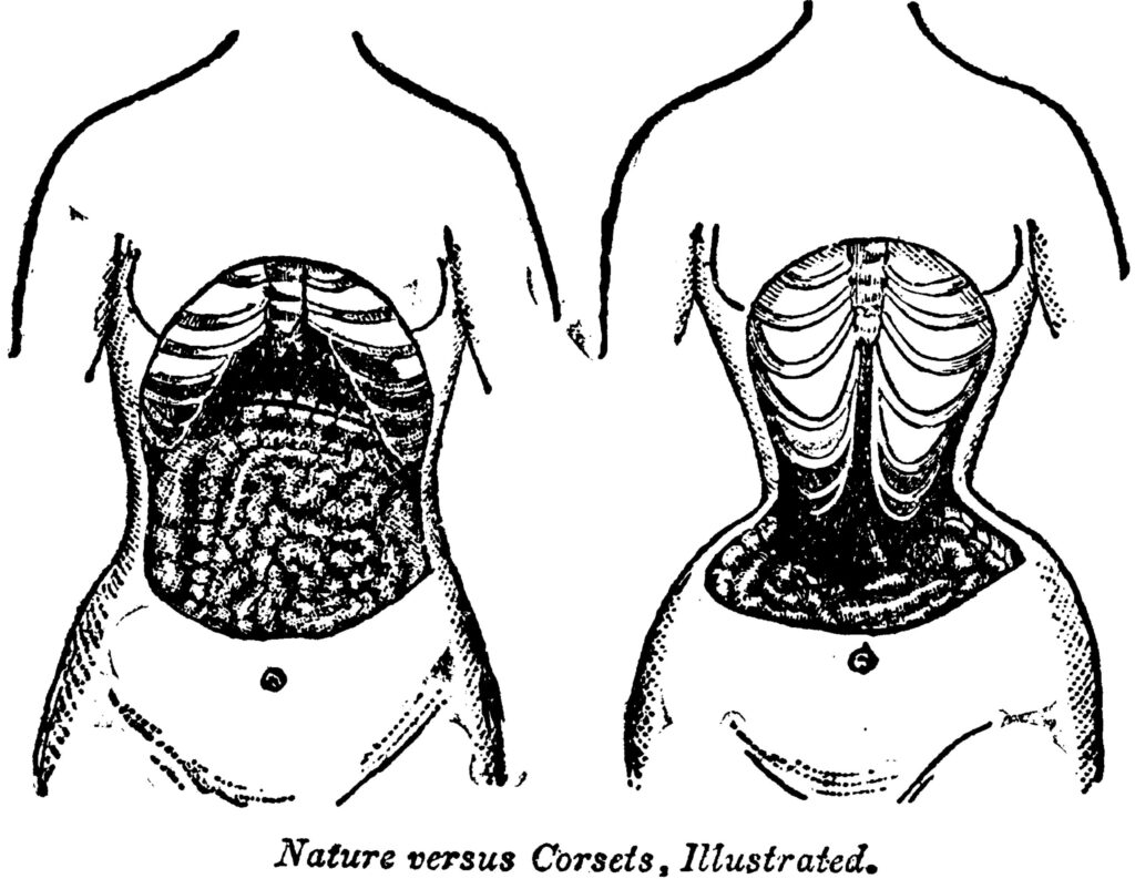 illustratsioon sellest, mida korseti kandmine naise kehaga teeb. vasakul pool on torso, milles näeb elundite normaalset paiknemist, paremal aga selline torso, kus ribid on pidevast korsetikandmisest kokku surutud ning soolikad ja muud elundid paiknevad tavapärasest tunduvalt allpool.